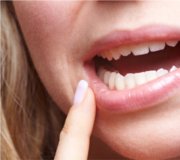 lippenherpes Preisvergleich